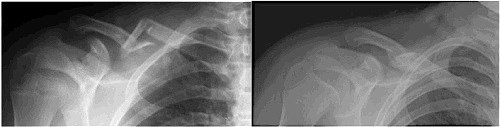 fractured clavicle