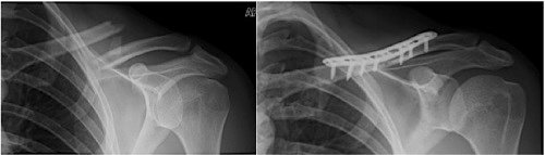 fractured clavicle