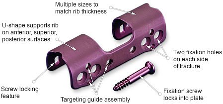 rib repair plate