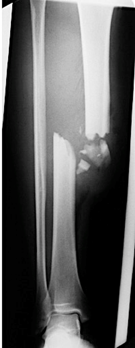 x-ray of broken tibia