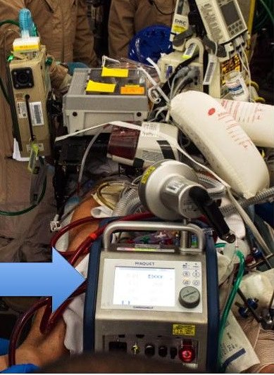 portable ECMO therapy device