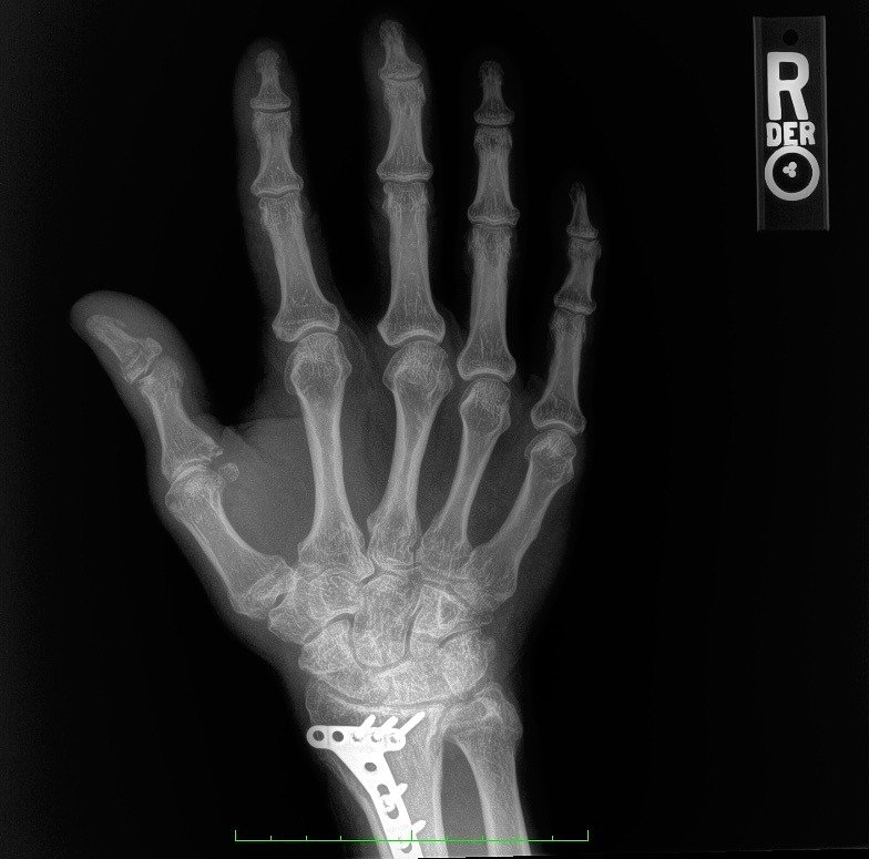 X-ray of hand with surgical hardware